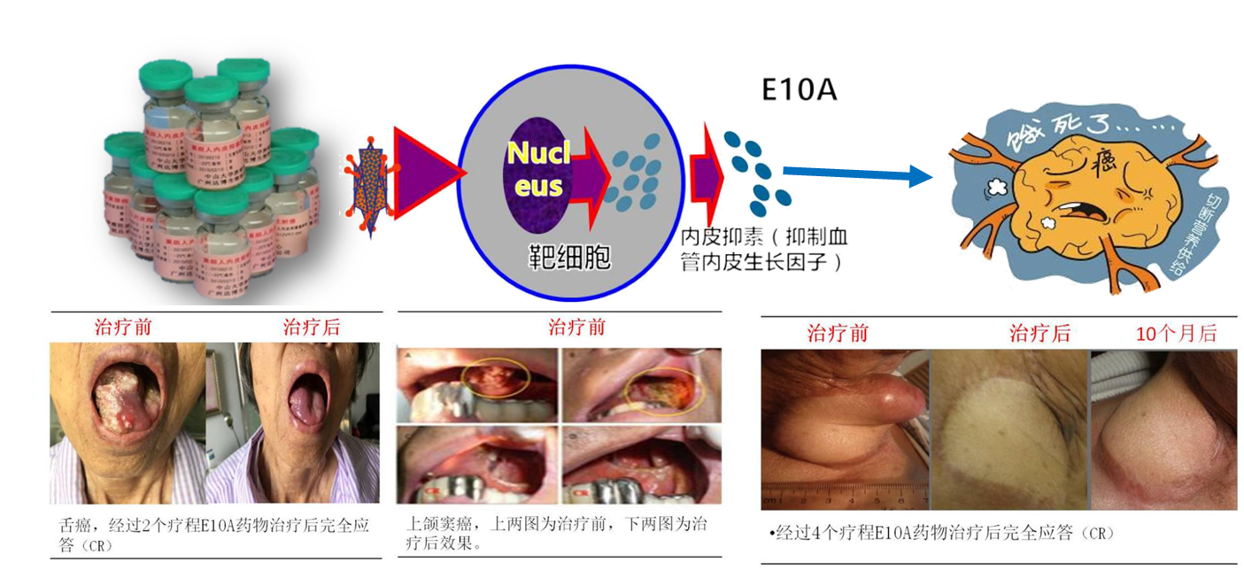 E10A臨床案例